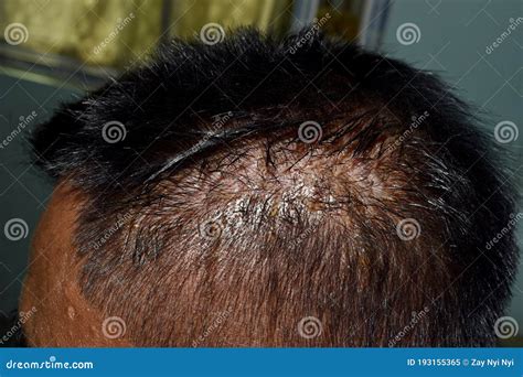 Seborrheic Dermatitis At The Scalp Of Southeast Asian Myanmar Adult