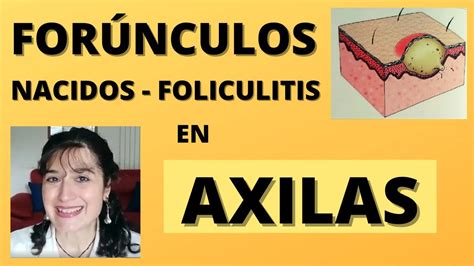 ¿te Salen Granos Rojos Abajo Del Brazo Foliculitis En Axilas Nacidos