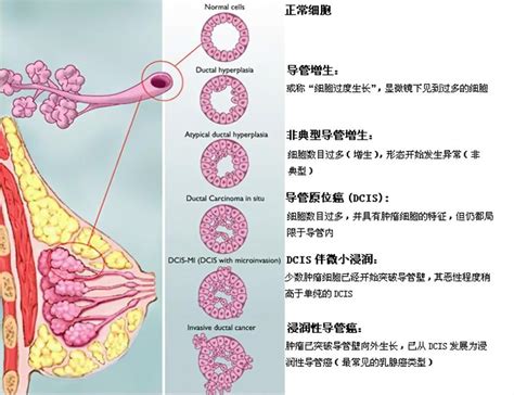 乳腺癌病理报告到底该如何看？教你读懂乳腺癌病理报告单 知乎