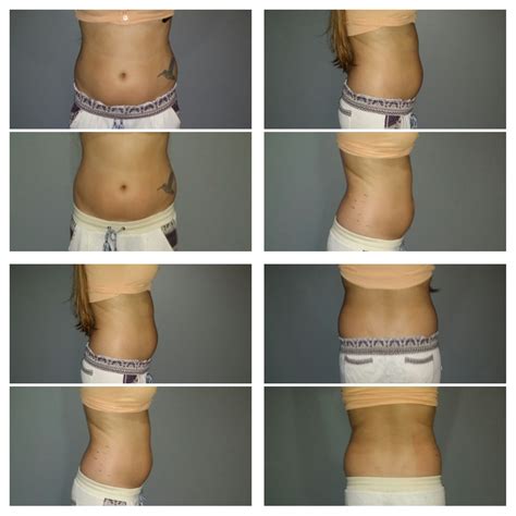 Spa810 Strawberry Laser Lipo Treatment Best Self Atlanta