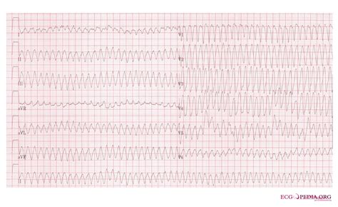 Fileventricular Flutter 12lead Ecgpedia