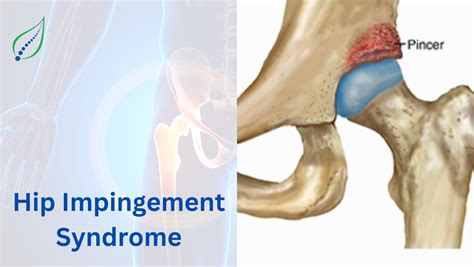 Non-Surgical Treatment for Hip Impingement Syndrome | Best Back Pain, Slip Disc, Knee Arthritis ...