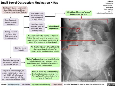 Small Bowel Obstruction: Findings on X-Ray | Calgary Guide