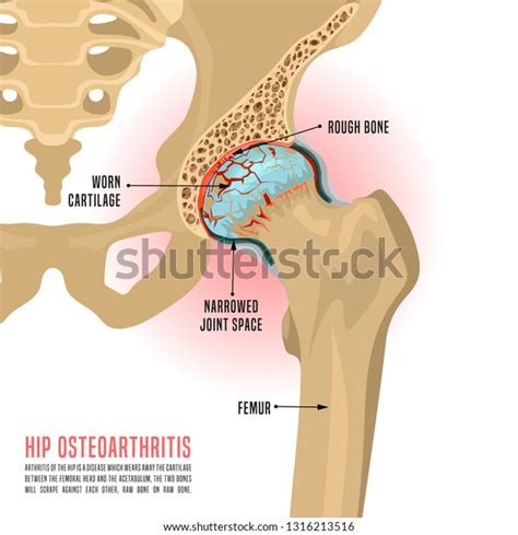 Hip Osteoarthritis Infographic Realistic Bones Scheme Stock Vector