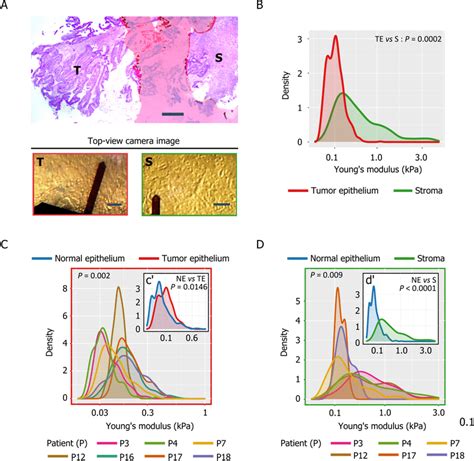 Stiffness Of Tumor Epithelium And Stroma Rich Regions Of Crc Samples