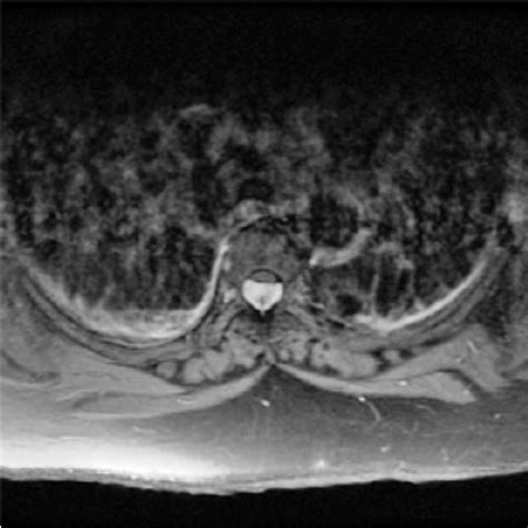 Postcontrast T1 Weighted Axial Magnetic Resonance Image Demonstrates A