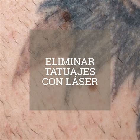 Eliminaci N Tatuajes Con L Ser Epidermos Instituto De Dermoest Tica