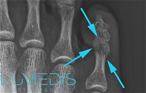 Kleiner Zeh Gebrochen Lumedis Ihre Fu Spezialisten