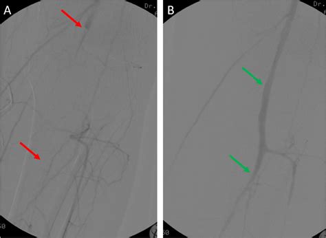 Intraoperative Angiography Prior To Revascularization Showing Complete