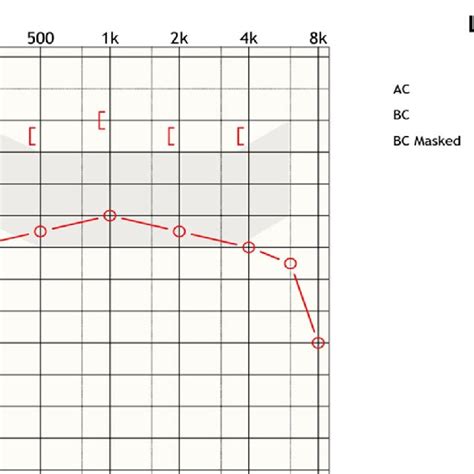 Pure Tone Audiometry Of Year Old Patient Of Motor Vehicle Accident