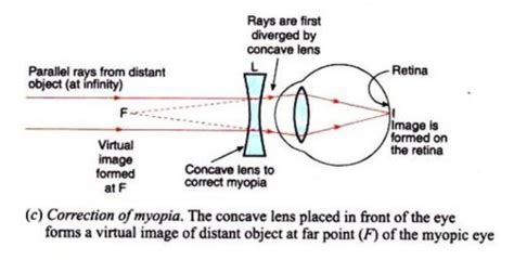 Defects Of Vision And Their Correction Class 10 The Human Eyes And The Colorful World