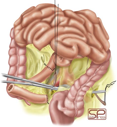 Ileal Conduit As The Standard For Urinary Diversion After Radical