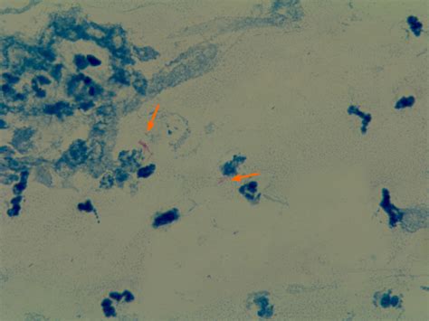 Bacterial culture of pyogenic fluids. The arrows indicate acid-fast ...