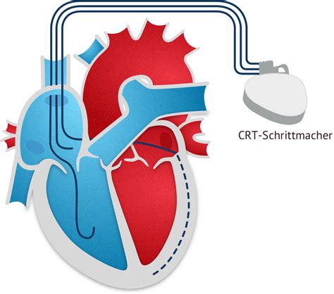 Operation Bei Herzinsuffizienz Herzbewusst De
