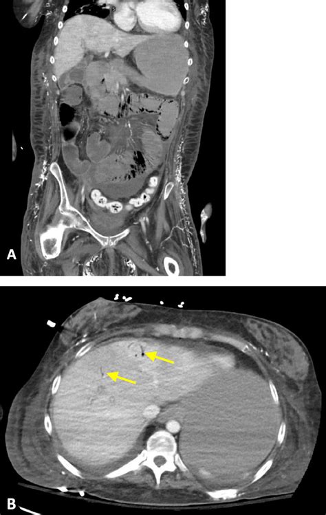 Ct Of The Abdomen And Pelvis With Iv Contrast On Hospital Day 10 A