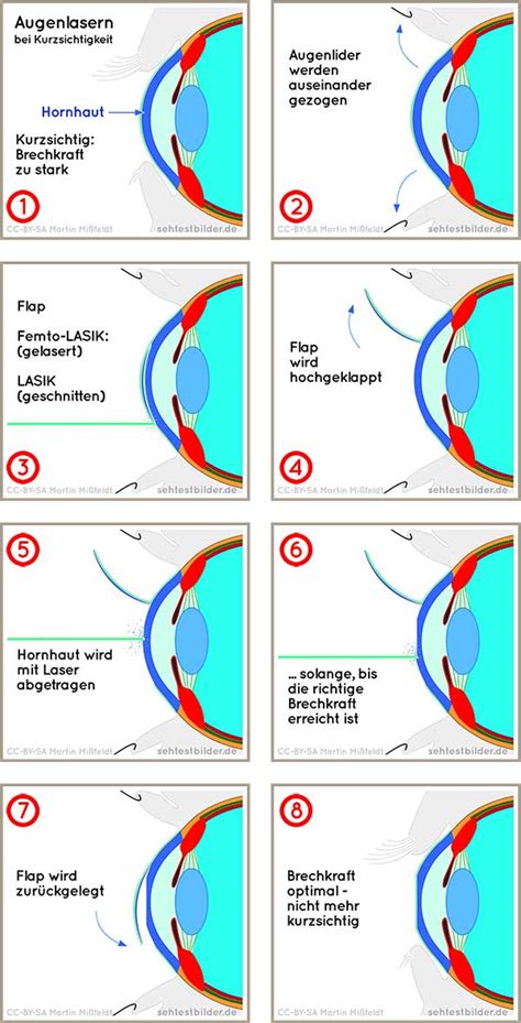 Augenlasern Lasik Verfahren Kosten Risiken