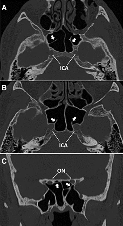 Relationship Between Sphenoid Sinus Volume And Accessory Septations A