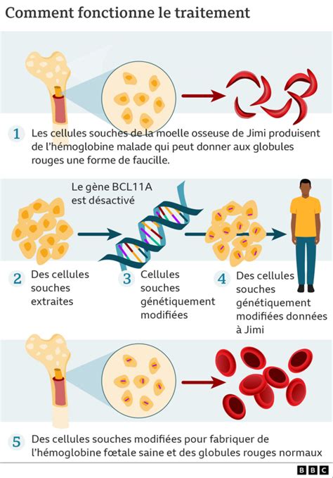 Drépanocytose le traitement révolutionnaire par modification