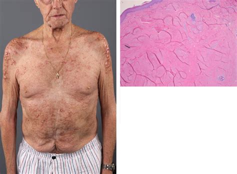 Nodular Scleroderma Spierings 2015 Arthritis And Rheumatology