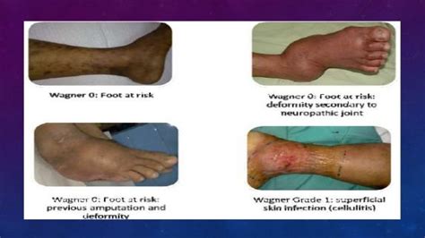 Diabetic Foot Ulcer Wagner Scale