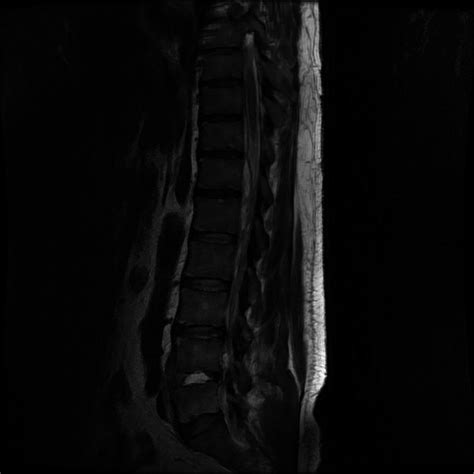 Lumbar Magnetic Resonance Imaging On The Second Day Of Hospitalization