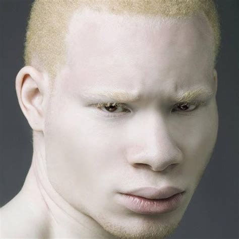 Pin By Saida El Haddaji On Portraits Albinism Albino American