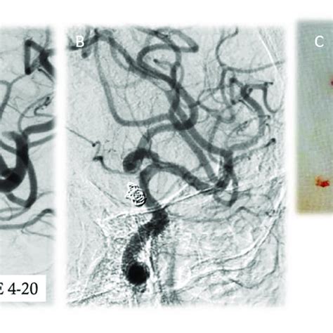 Aneurysm Tissues Retrieval By A Solitaire Stent Retriever In