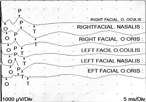 Facial Nerve Conduction Study Showing Reduction In The Compound Muscle