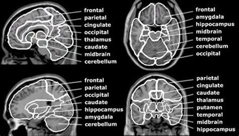 View Brain Anatomy In Mri PNG