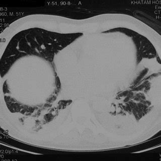 Chest CT Shows A Large Rounded Hyperdense Mass In The Middle Lobe Of