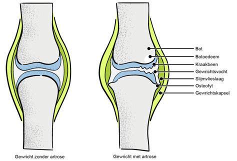 Artrose Gezond Alles Wat U Moet Weten Over Artrose