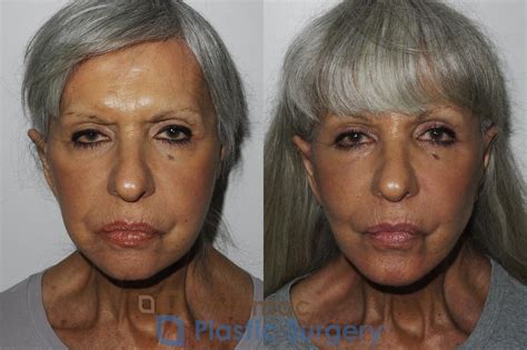 Facelift Before After Photos Patient Washington Dc Arlington