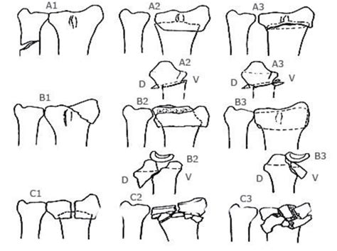 Sistema De Clasificación Aoota 23 A1 Extraarticular A2 Download Scientific Diagram