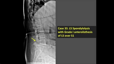 L5 Spondylolysis With Grade I Anterolisthesis Of L5 Over S1 X Ray