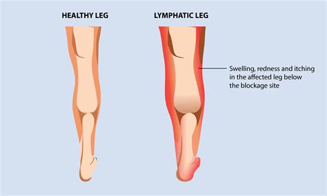 Causes Of Lymphedema Lower Leg