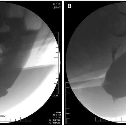 Rectocele depth before and after surgery. *P