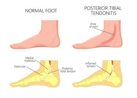 Shoes for Post-Tib Tendonitis in Visalia and Bakersfield