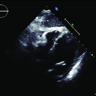 Two Dimensional Echocardiography With Definity Showing Lv Thrombus