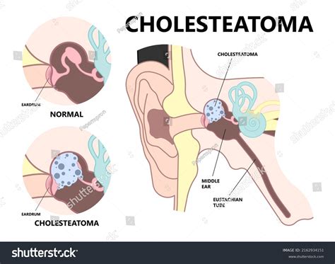 Mastoiditis Anatomy