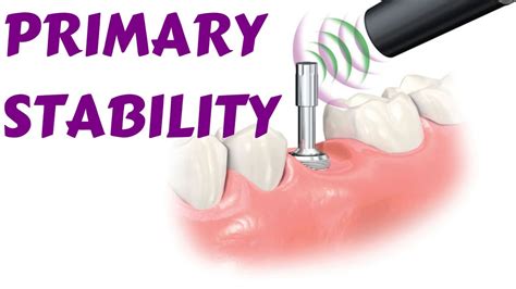 Primary Dental Implant Stability Factor Affecting Primary Stability