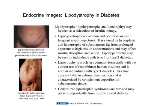 images  endocrine disorders