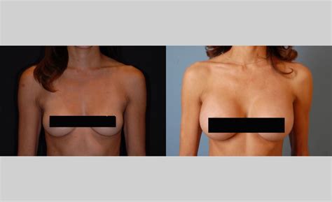 Top Plastic Surgeon Thousand Oaks Ca Azar Plastic Surgery Breast