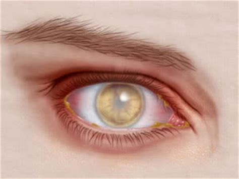 Trachoma Disease Symptoms and Treatment | Disease Information And ...