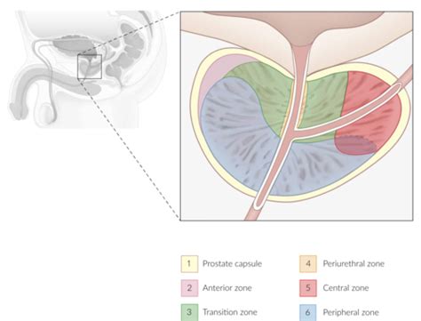 Hyperplasie B Nigne De Prostate Hbp Cartes Quizlet