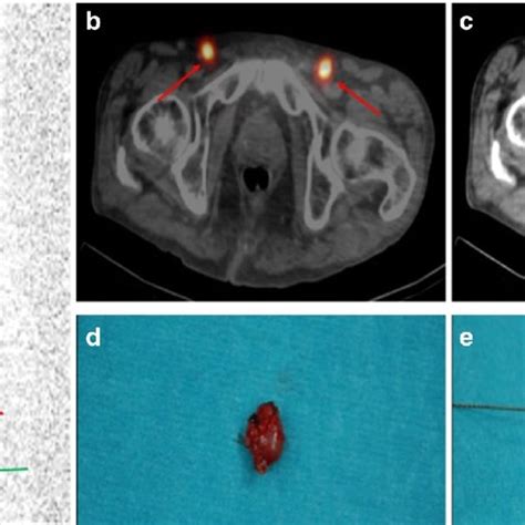 Sentinel Lymph Node Biopsy Slnb Guided By Lymphoscintigraphy [39] In Download Scientific