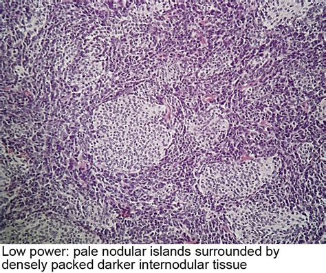 Pathology Outlines Desmoplastic Nodular Medulloblastoma