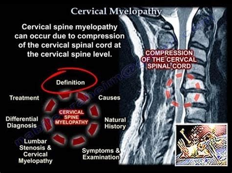 Cervical Myelopathy What To Know