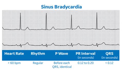 Arrhythmia Recognition Part 1 Clinical View