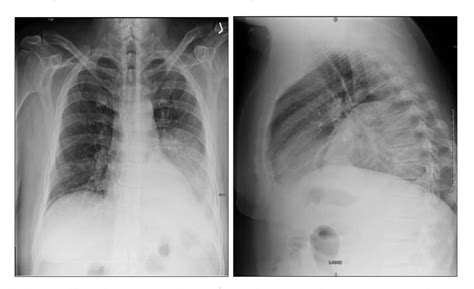 Figure 1 from Lung abscess caused by Streptococcus intermedius in an immunocompetent patient ...