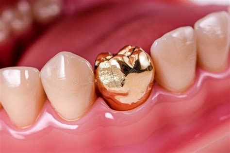 Dental Gold Fillings Used To Fill Gold Cavities On Tooth Stock Image